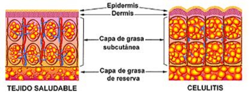 Ejercicios para eliminar la celulitis 8 celulitis